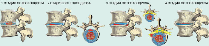 stepeni-stadii-osteohondroza